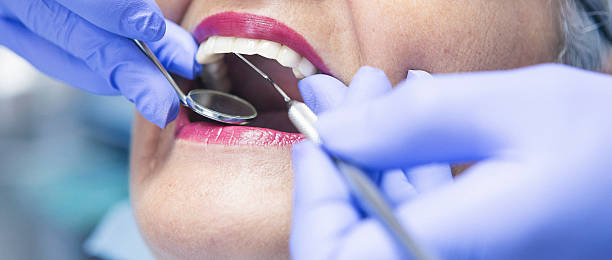 Best Emergency Dentist for Lost Fillings or Crowns in Bell, CA